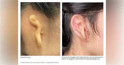 20-Year-Old Gets a Functional 3D Printed Ear Made From Her Own Tissue